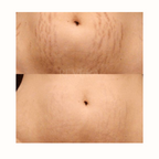 Olio smagliature Revèra