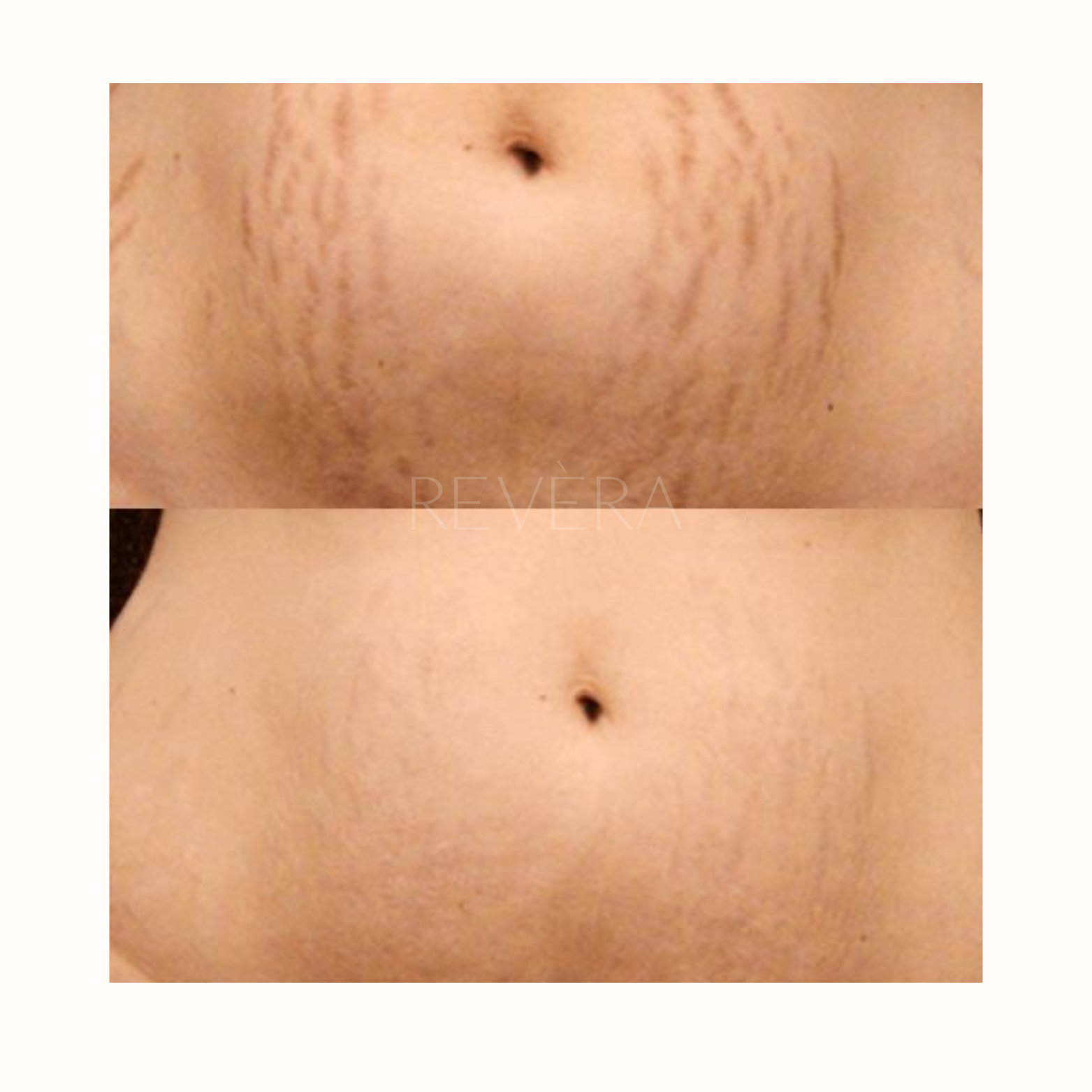 Olio smagliature Revèra