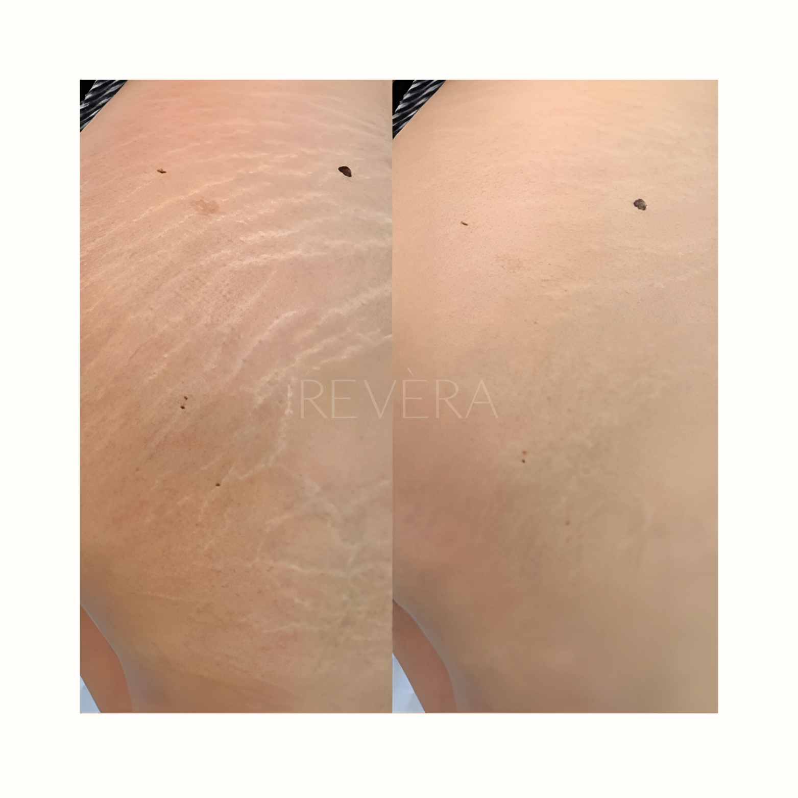 Olio smagliature Revèra